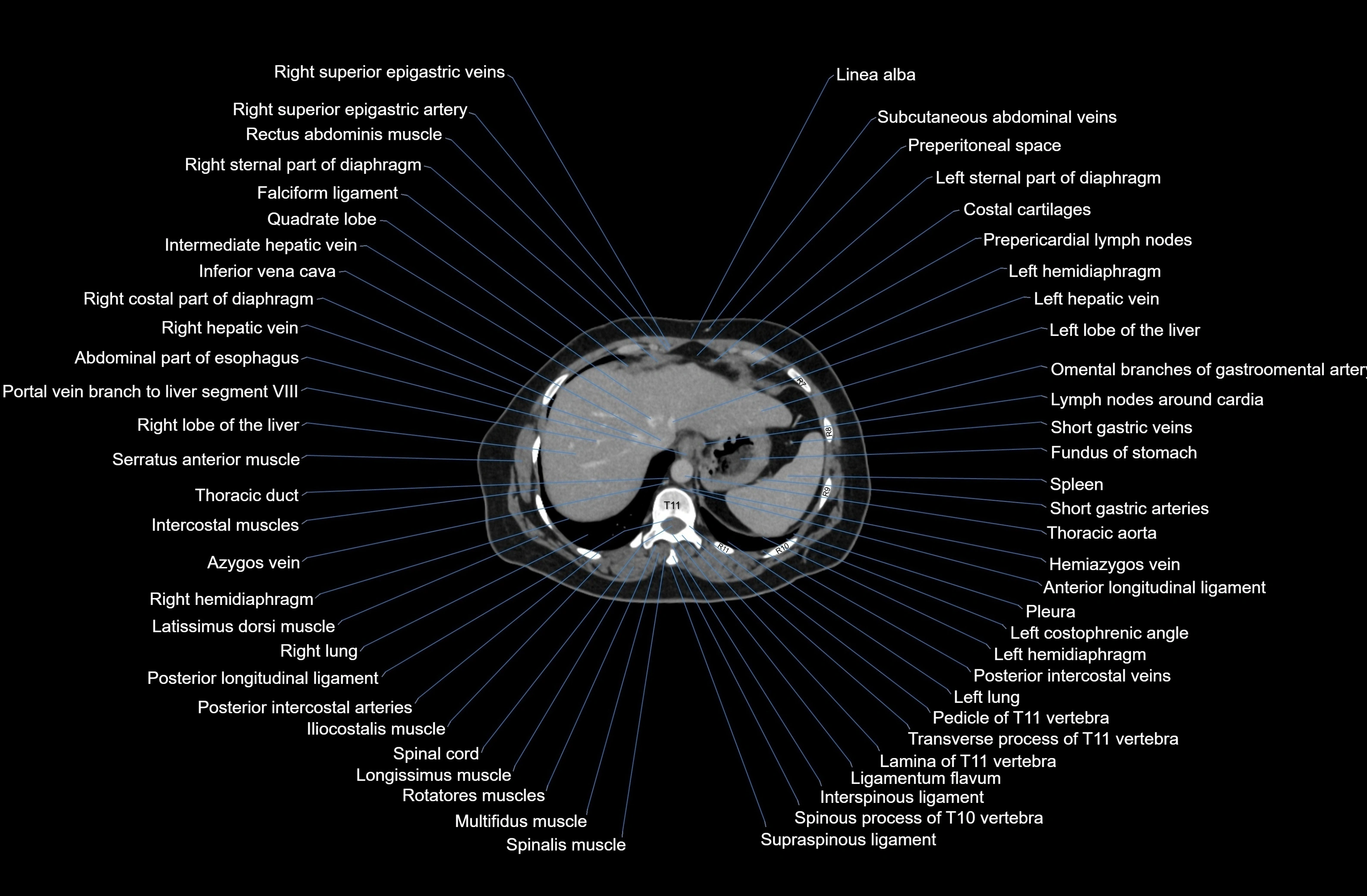 CT Abdomen axial cross sectional anatomy labelled radiology image-00012.webp